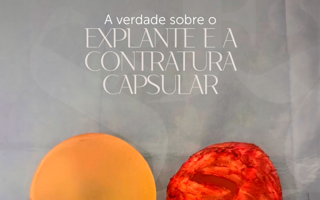 A verdade sobre o Explante e a Contratura Capsular