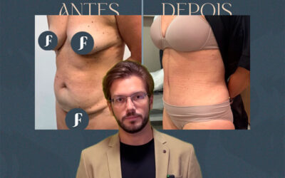 Cicatriz da abdominoplastia